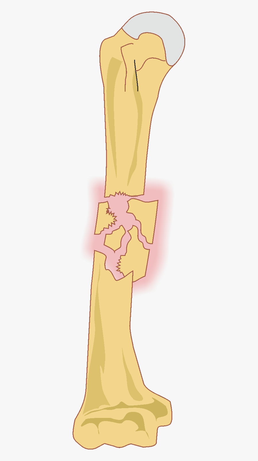Fracture Shaft Of Bone - Cross, Transparent Clipart