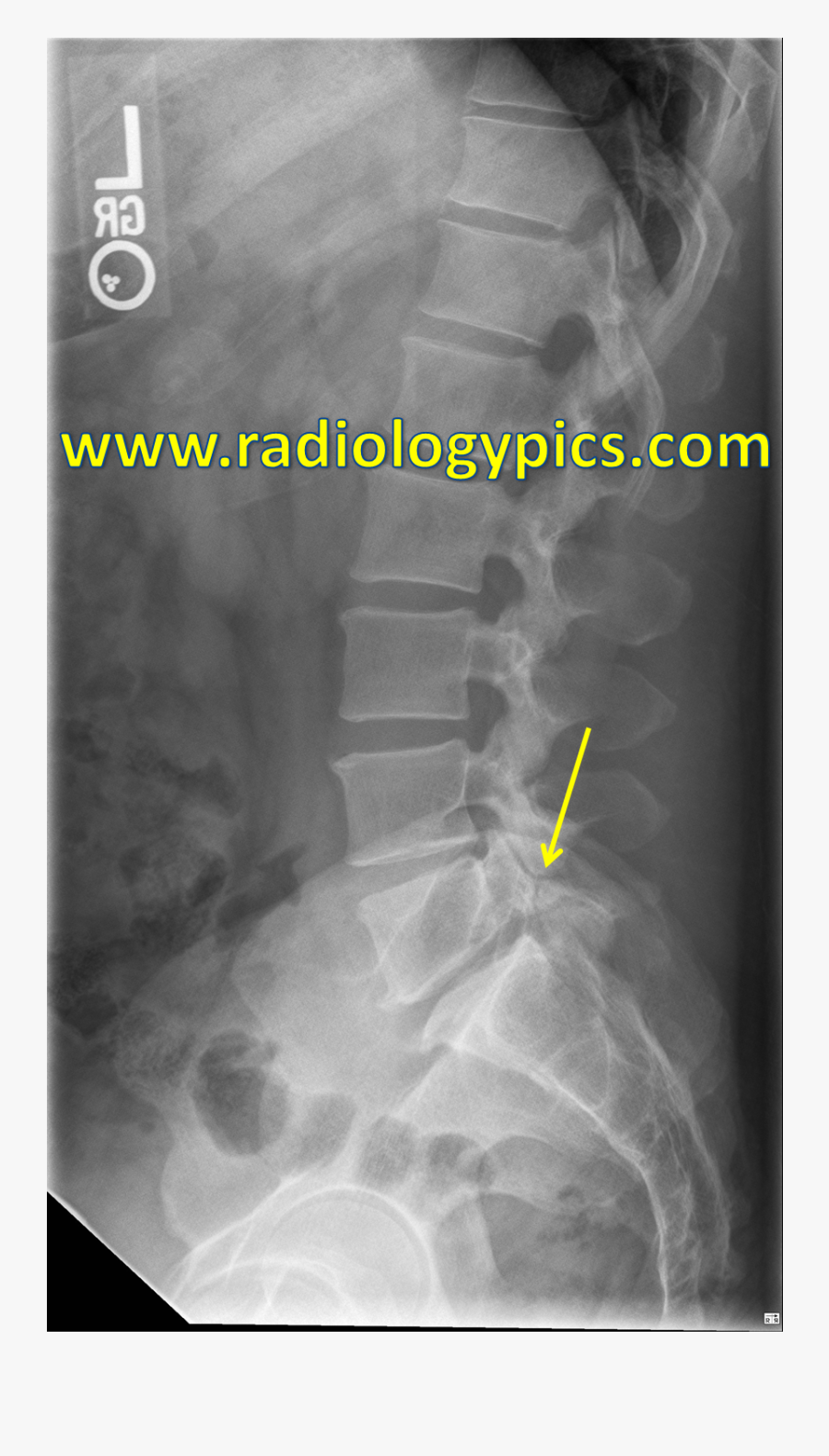 Clip Art Holy Crap This X - L5 Pars Defect X Ray, Transparent Clipart