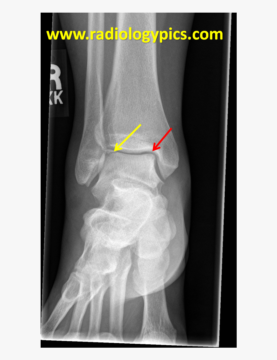 Clip Art Fat Person Xray - Medical Radiography, Transparent Clipart