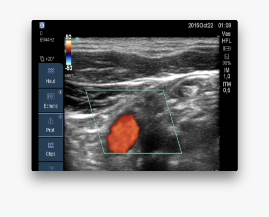 Clipart Free Download Blood Flow Monitoring Common - Left Abnormal Blood Flow Common Carotid Artery Color, Transparent Clipart