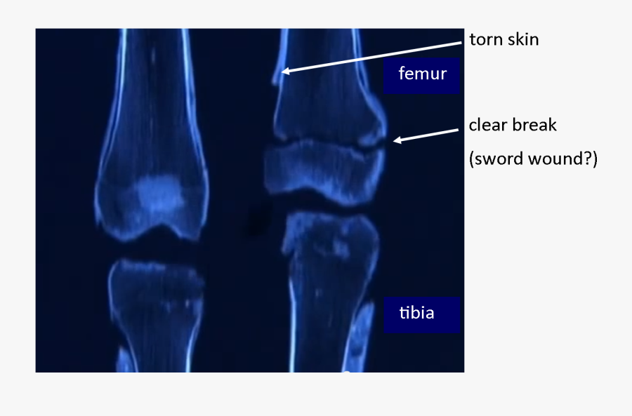 Knee3 - King Tut Broken Femur, Transparent Clipart