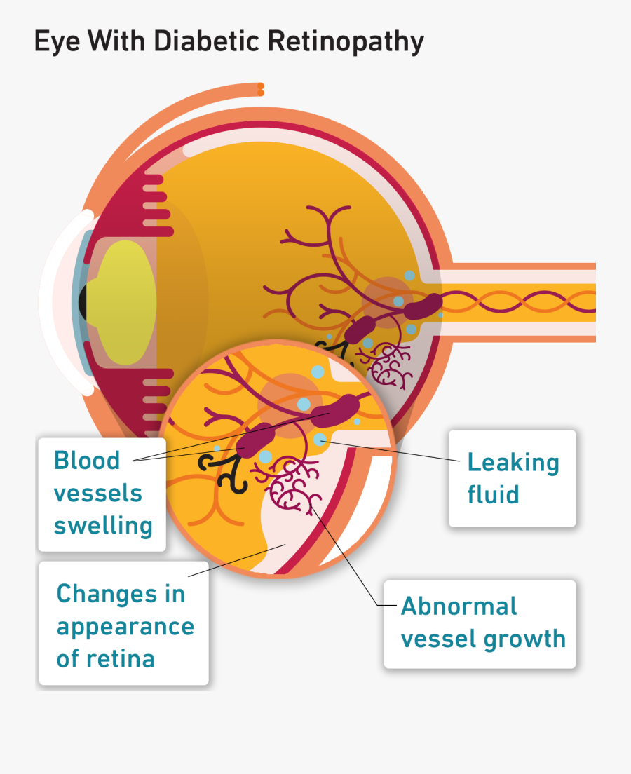 Diabetic Retinopathy And Macular Edema Difference, Transparent Clipart