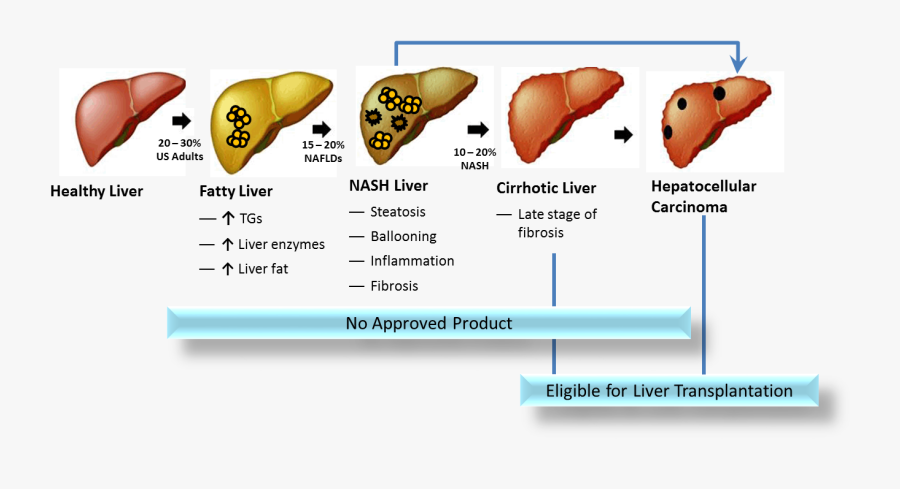 Liver Clipart Cirrhosis - Fatty Liver Progression, Transparent Clipart