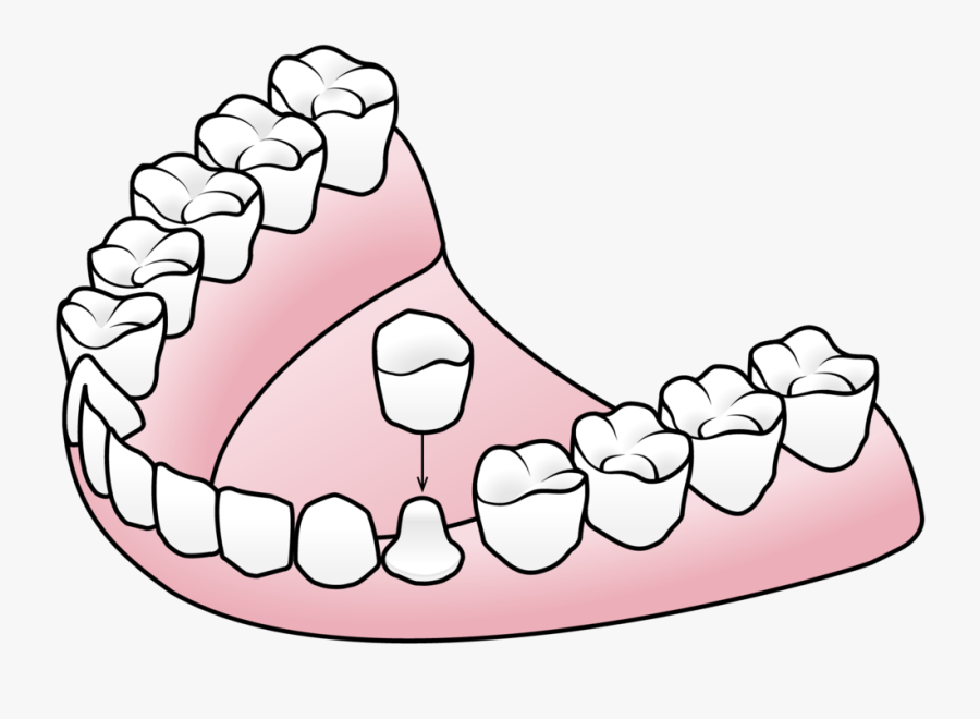 Tooth Clipart Crown - Implant Supported Denture Components, Transparent Clipart