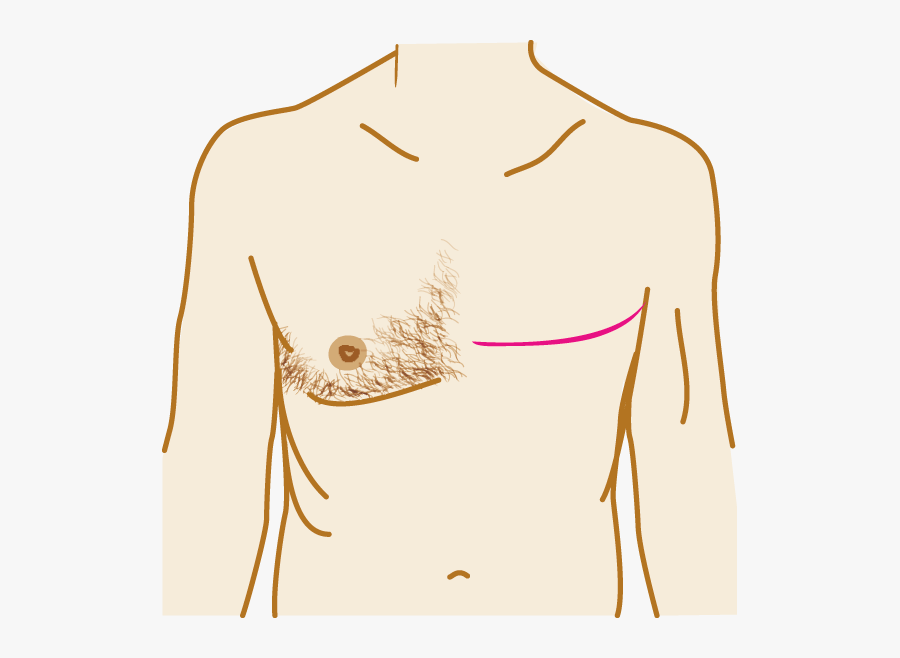 Male Breast Cancer Treatment, Transparent Clipart