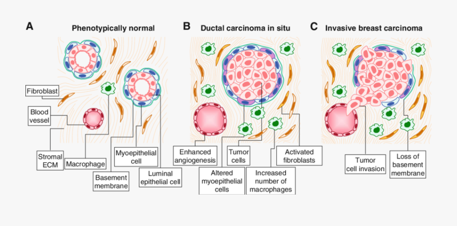 Stromal Alterations In Breast Cancer Progression - Myoepithelial Cells In Breast Cancer, Transparent Clipart