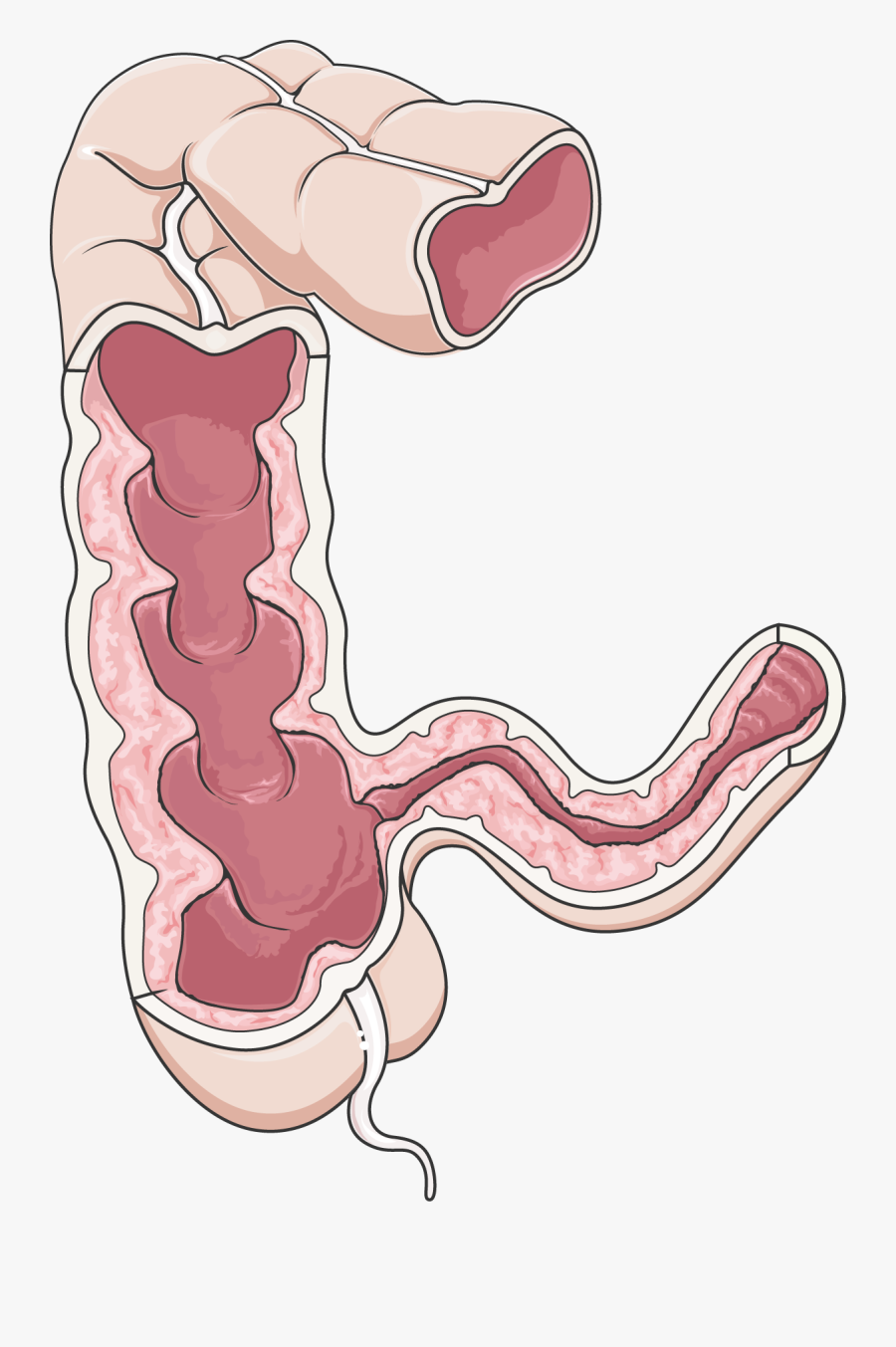 Colon - Crohn's Disease Png, Transparent Clipart