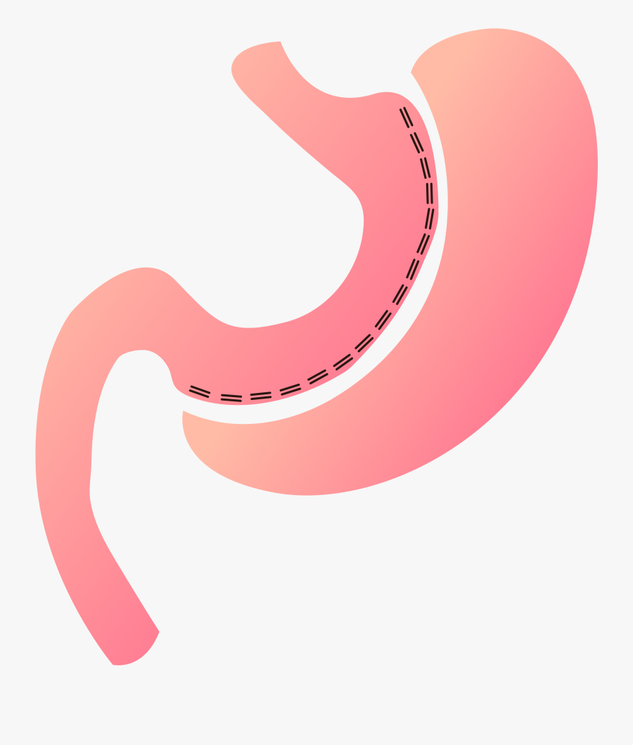 Artboard 46@300x - Gastric Sleeve Art, Transparent Clipart