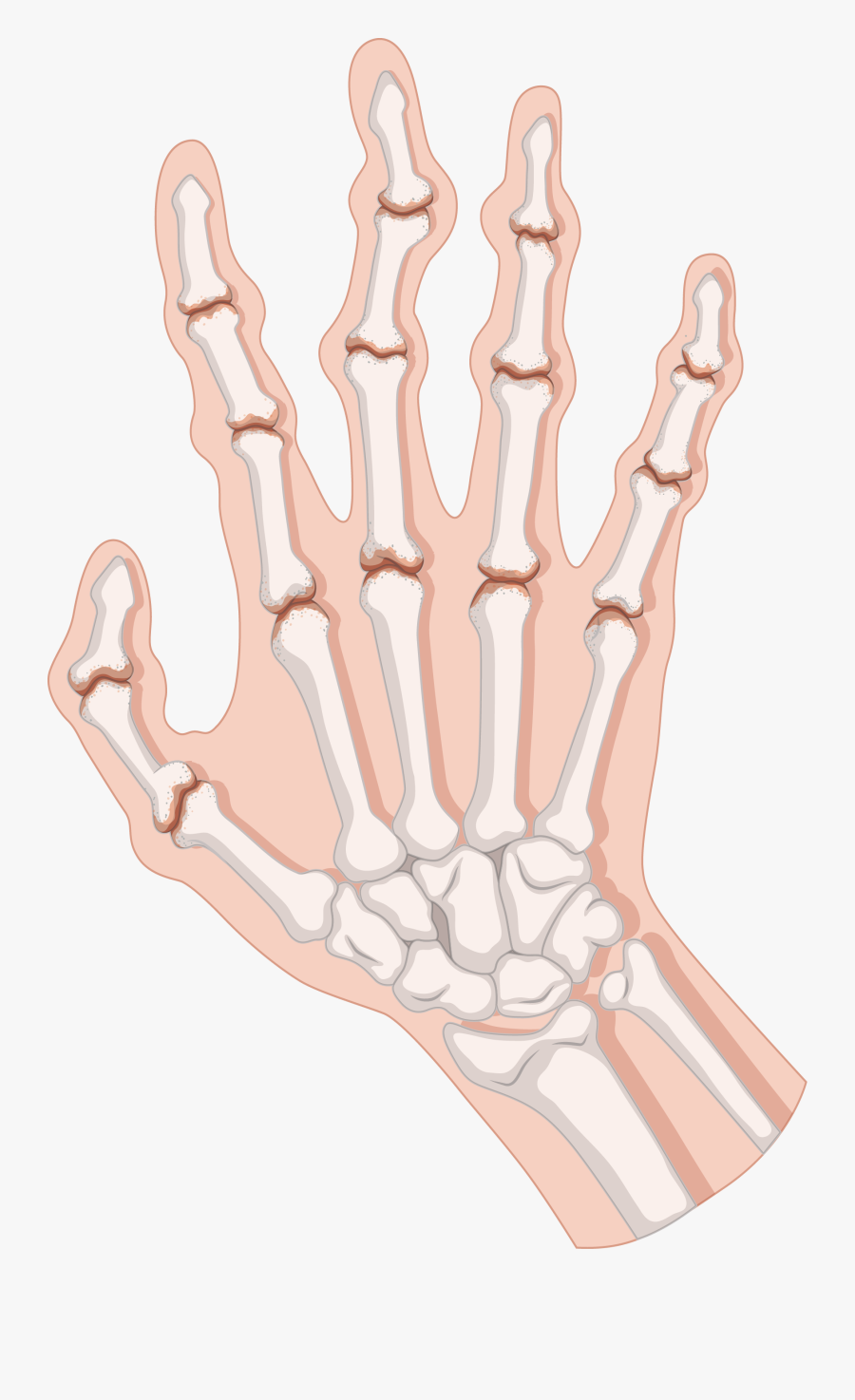 Rheumatoid Arthritis Clip Art - Rheumatoid Arthritis Bone Transparent, Transparent Clipart