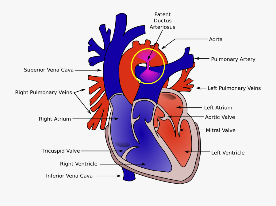 Patent Ductus Arteriosus, Transparent Clipart