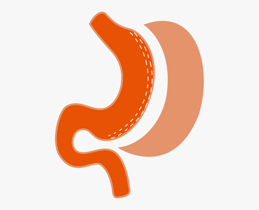 Laparoscopic Sleeve Gastrectomy Is A Type Of Weight - Laparoscopic Sleeve Gastrectomy, Transparent Clipart