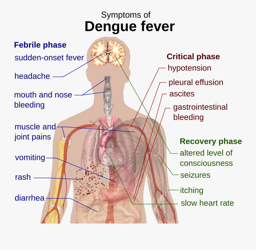 Disease Clipart Dengue Fever - Retro Orbital Pain In Dengue, Transparent Clipart