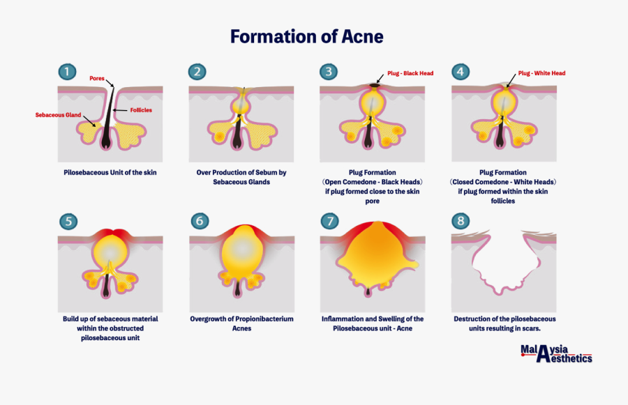 Clip Art Sebum Plug - Acne Vulgaris Images Of Pilo Sebaceous Unit, Transparent Clipart