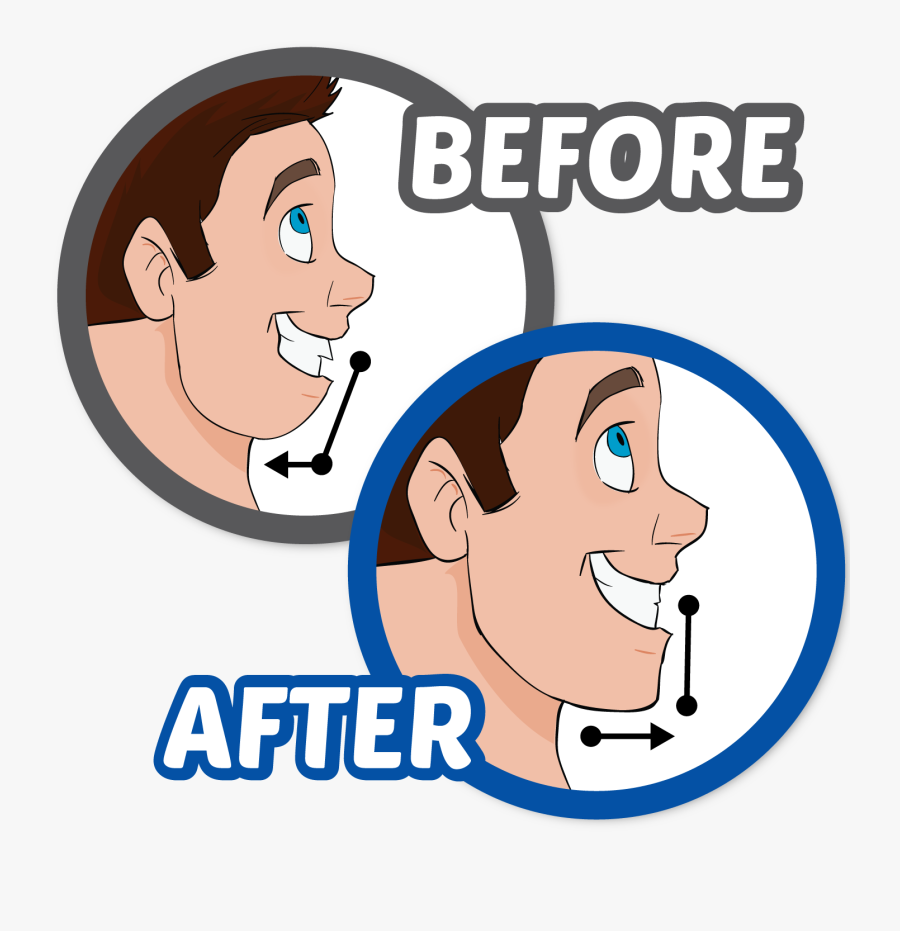 Transparent Braces Drawing Ear - Orthognathic Surgery Cartoon, Transparent Clipart