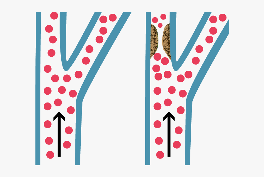 Illustration Of Carotid Artery Disease, Transparent Clipart