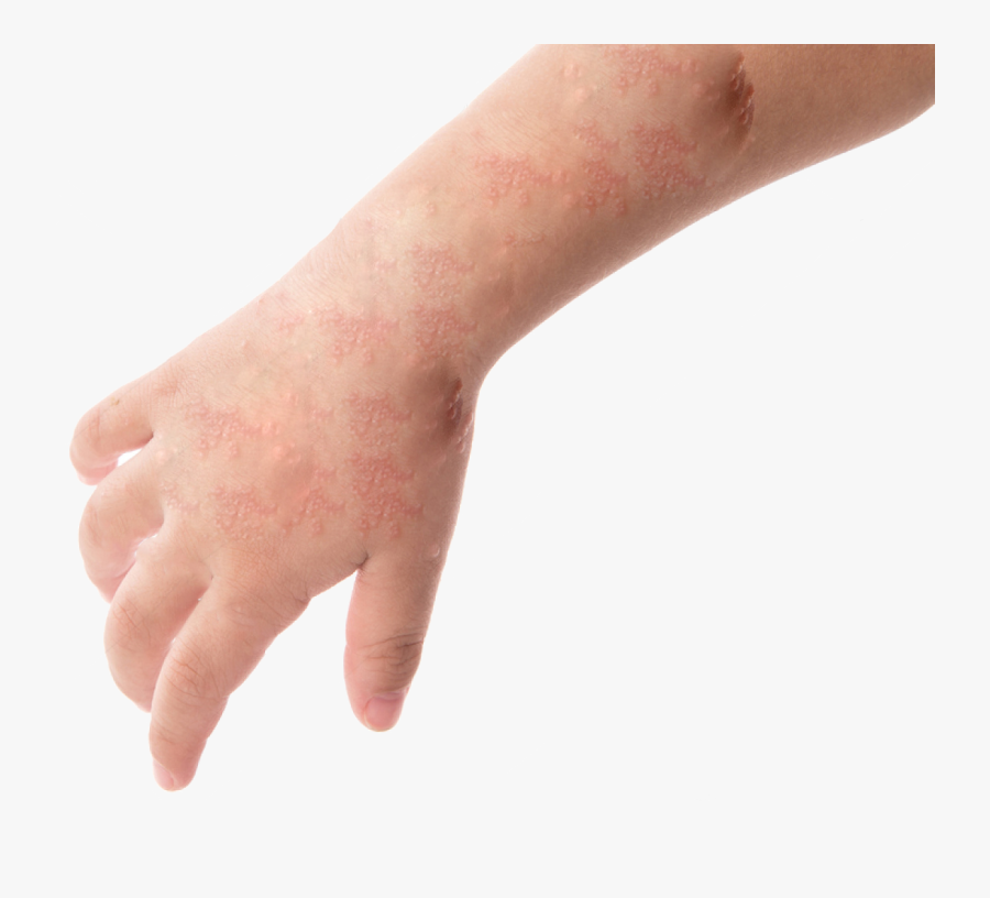 Hand Foot And Mouth Disease Top Of Hand , Transparent - Hand Foot And Mouth On Wrists, Transparent Clipart