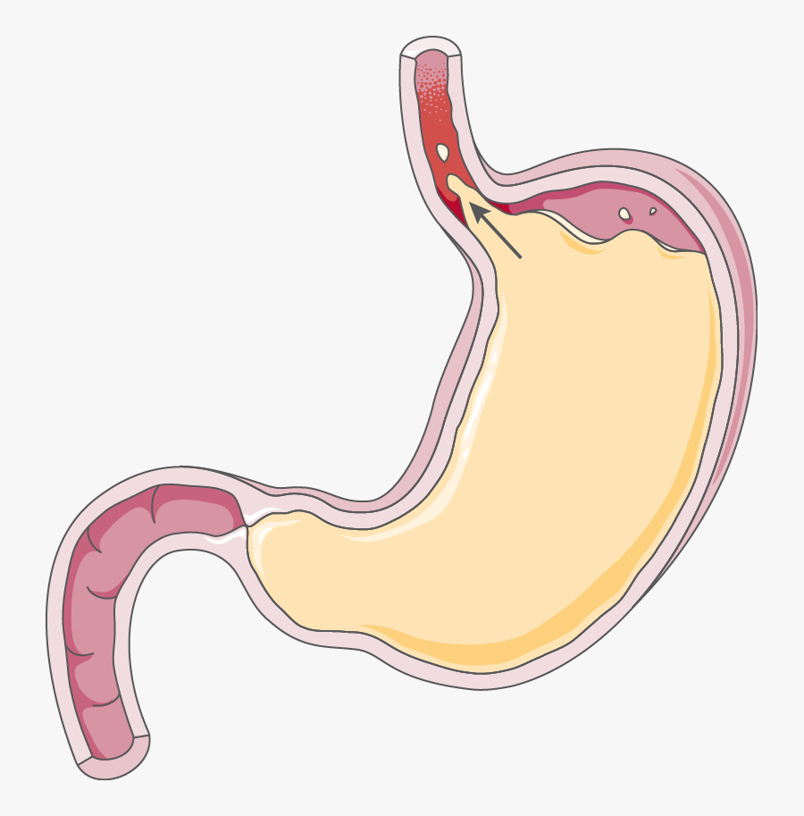 Reflux Gastrointestinal - Gastroesophageal Reflux Disease Transparent, Transparent Clipart