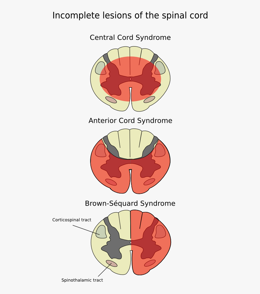 Cord-en - Brown Sequard Syndrome, Transparent Clipart