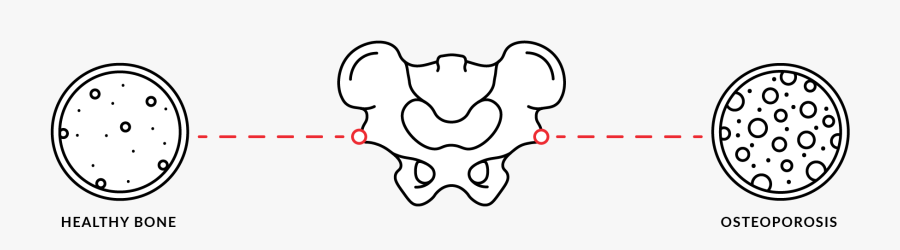 Osteoporosis Png Clipart, Transparent Clipart
