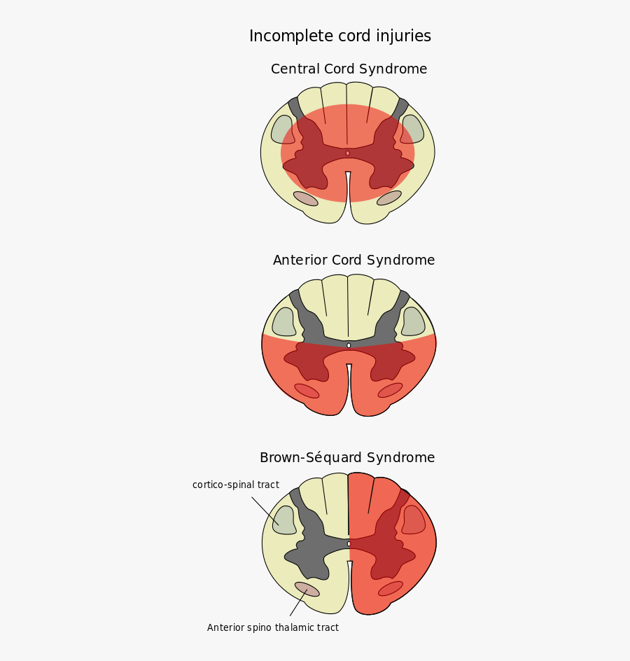 Central Cord Syndrome, Transparent Clipart