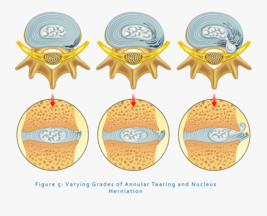 Degree Of Disc Bulge, Transparent Clipart