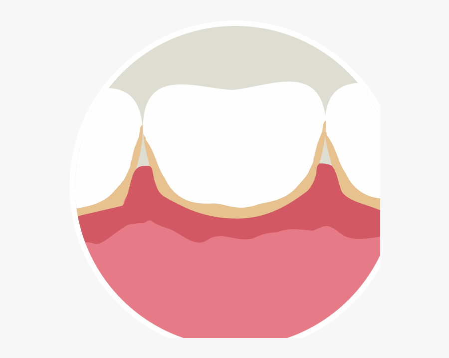 Utah Valley Oral And Maxillofacial Surgery - Bleeding Gums Png, Transparent Clipart