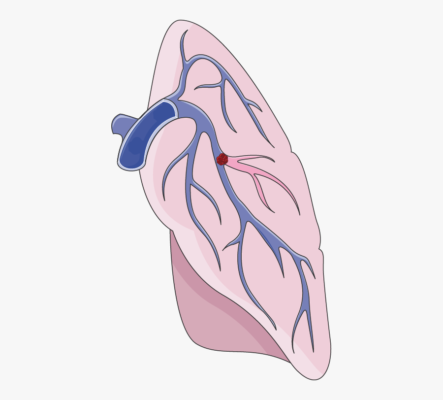 Pulmonary Embolism Clipart - Pulmonary Embolism Clip Art, Transparent Clipart