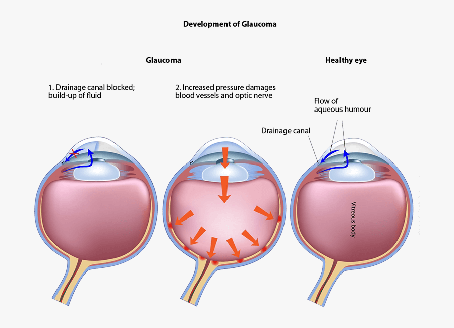 Chart Showing The Development Of Glaucoma In The Eye - Laser Cycloablation, Transparent Clipart