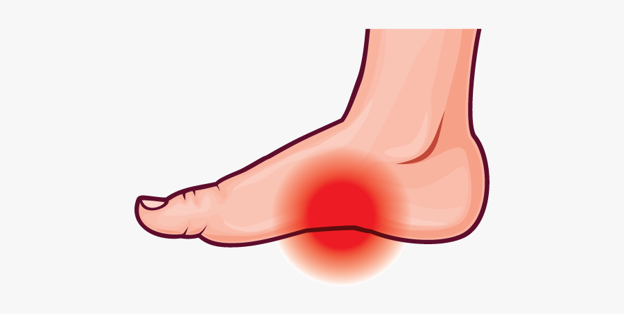 Arch Pain - Clip Art Foot Pain, Transparent Clipart