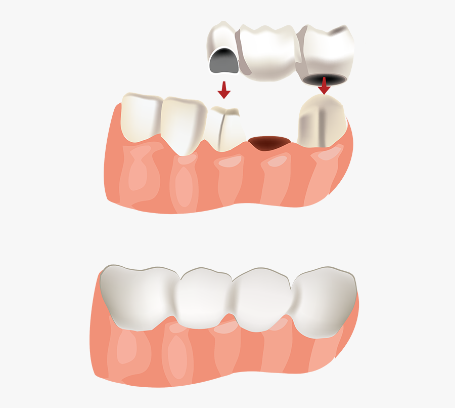 Tooth Clipart Crown - Brücke Mit 2 Kronen, Transparent Clipart