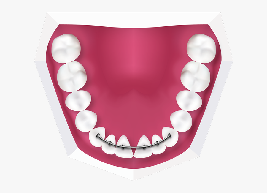 Fixed Retainers At Toothbeary - Space Maintainers For Kids, Transparent Clipart