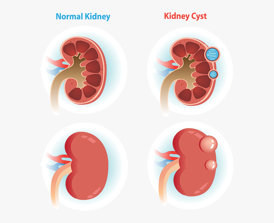 Comparison Of Normal Kidney Verse A Kidney With A Cyst - Kidney Cyst, Transparent Clipart