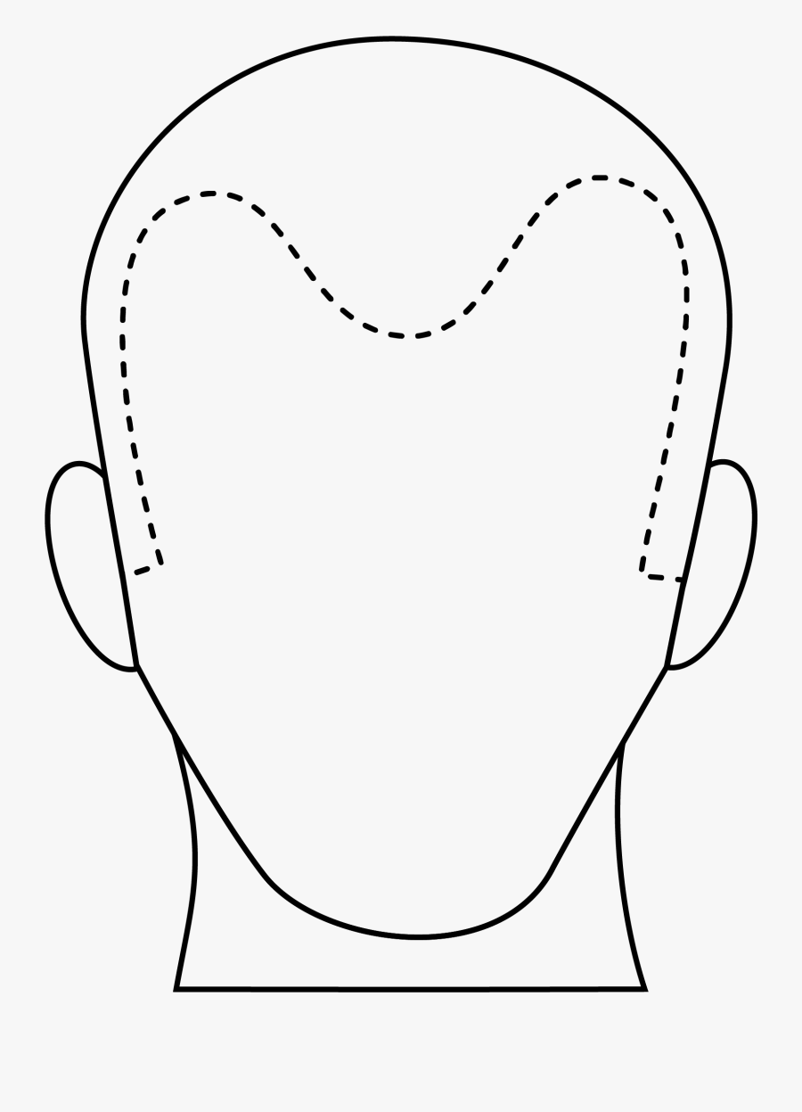 Male Hair Loss Line Art- - Line Art, Transparent Clipart