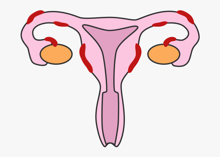 Endometriosis V2, Transparent Clipart