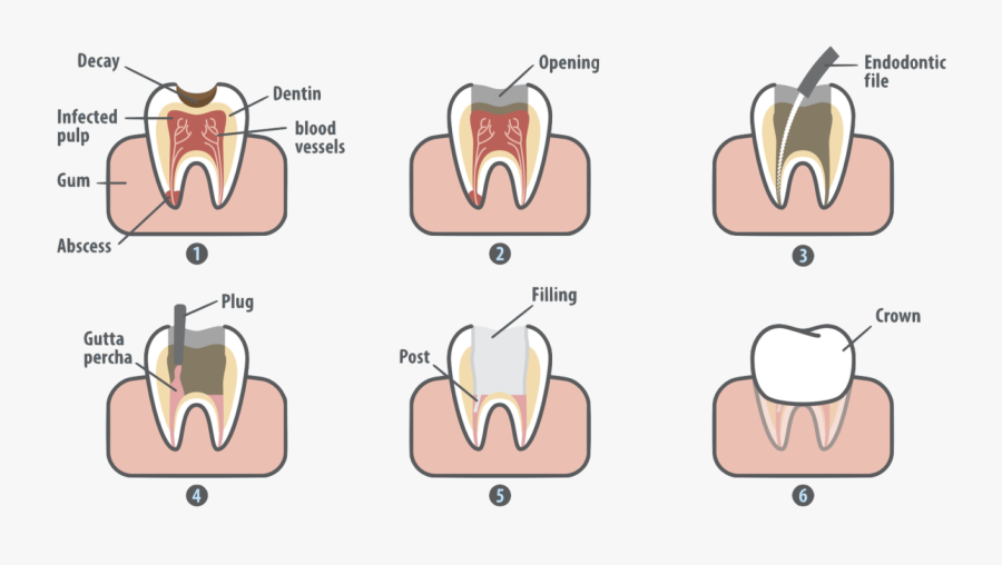 Root Canal In Marrero La - Root Canal, Transparent Clipart