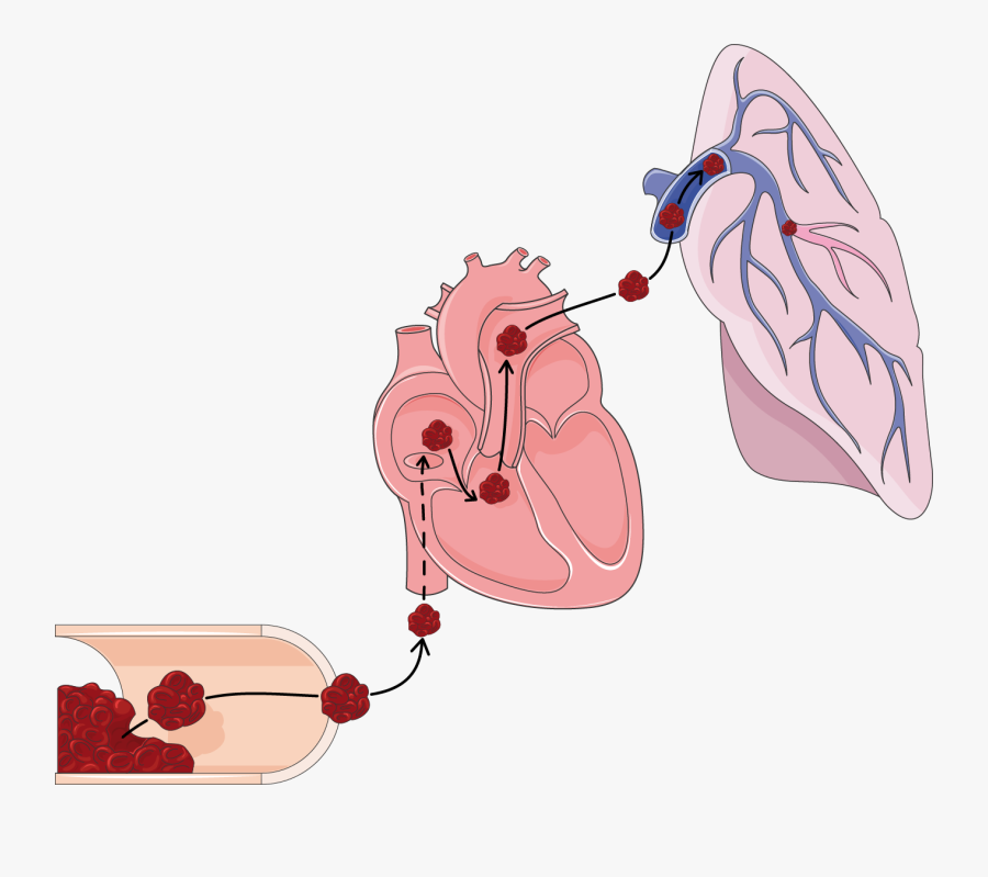 Pulmonary Embolism Clip Art, Transparent Clipart