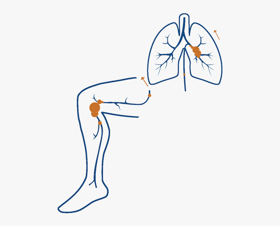 What Is Afib, Transparent Clipart