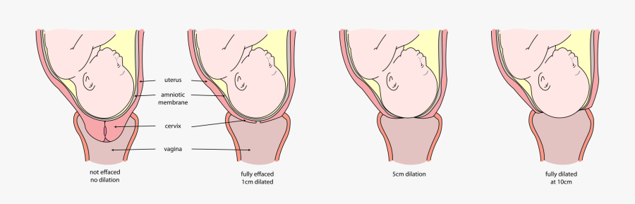 Pregnancy Clipart Preeclampsia - Col Ouvert A 1cm, Transparent Clipart