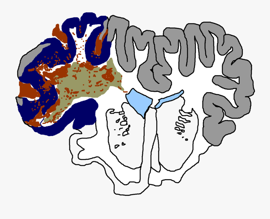 Traumatic Brain Injury Considered The Most Complex - Clip Art Of Brain Injury, Transparent Clipart