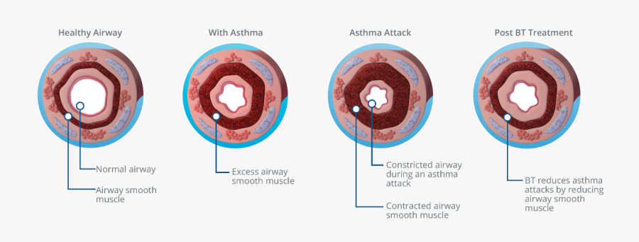 Thermoplasty Asthma, Transparent Clipart