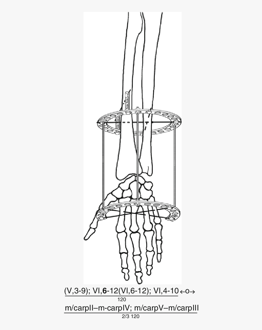 16 Distraction Device For The Wrist Joint - Drawing, Transparent Clipart