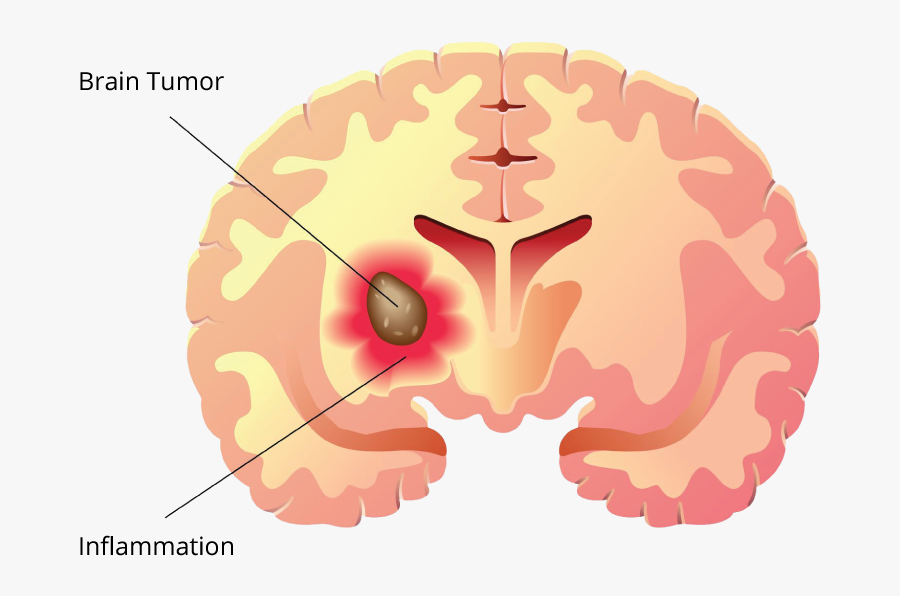 Brain Tumor Label - Brain Tumor Clipart, Transparent Clipart