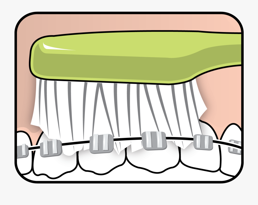 Tepe Supreme™ On Braces, Transparent Clipart