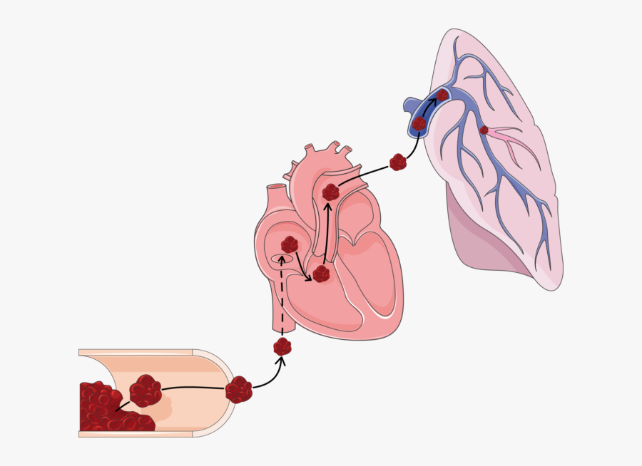 Pulmonary Embolism Clip Art, Transparent Clipart