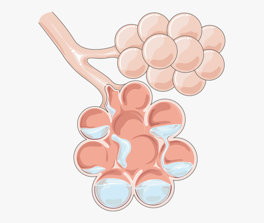 Pulmonary Edema, Transparent Clipart